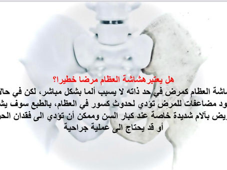 هل يعتبر هشاشة العظام مرضا خطيرا؟