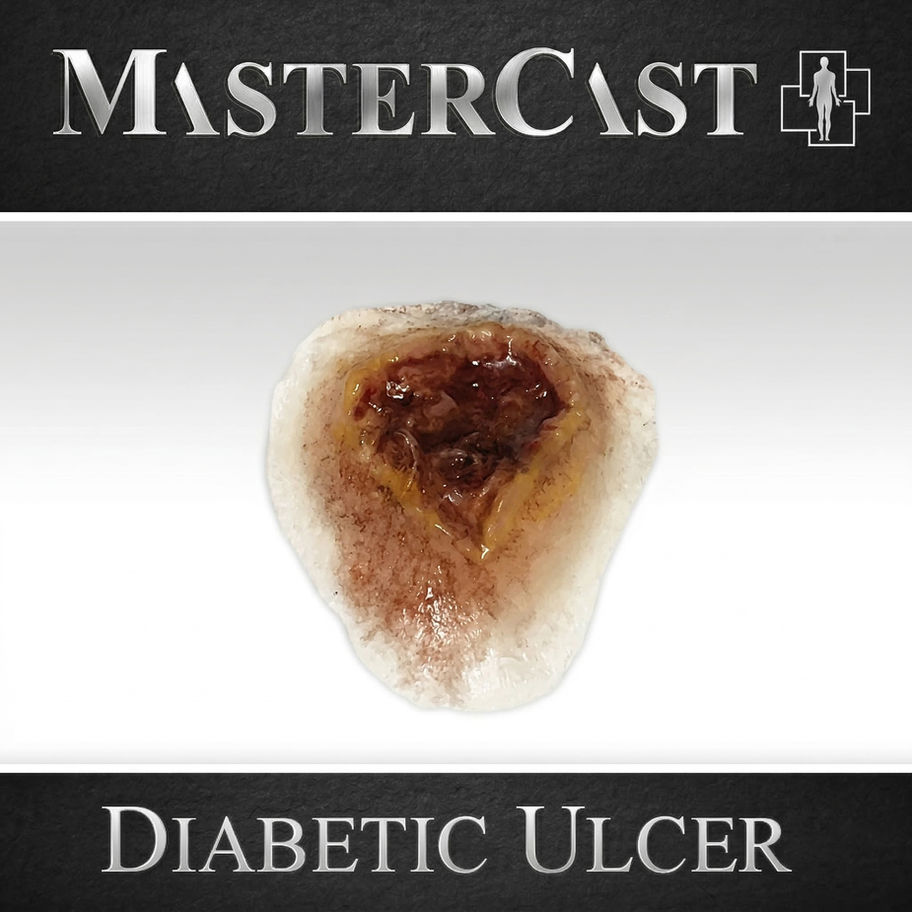 Diabetic ulcer for EMS Sim-Safe Kit