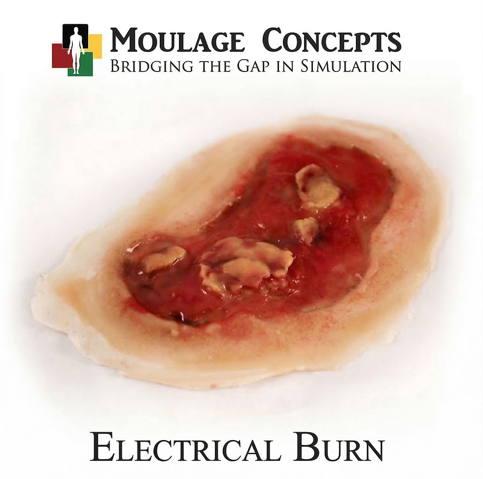 Electrical burn simulation moulage