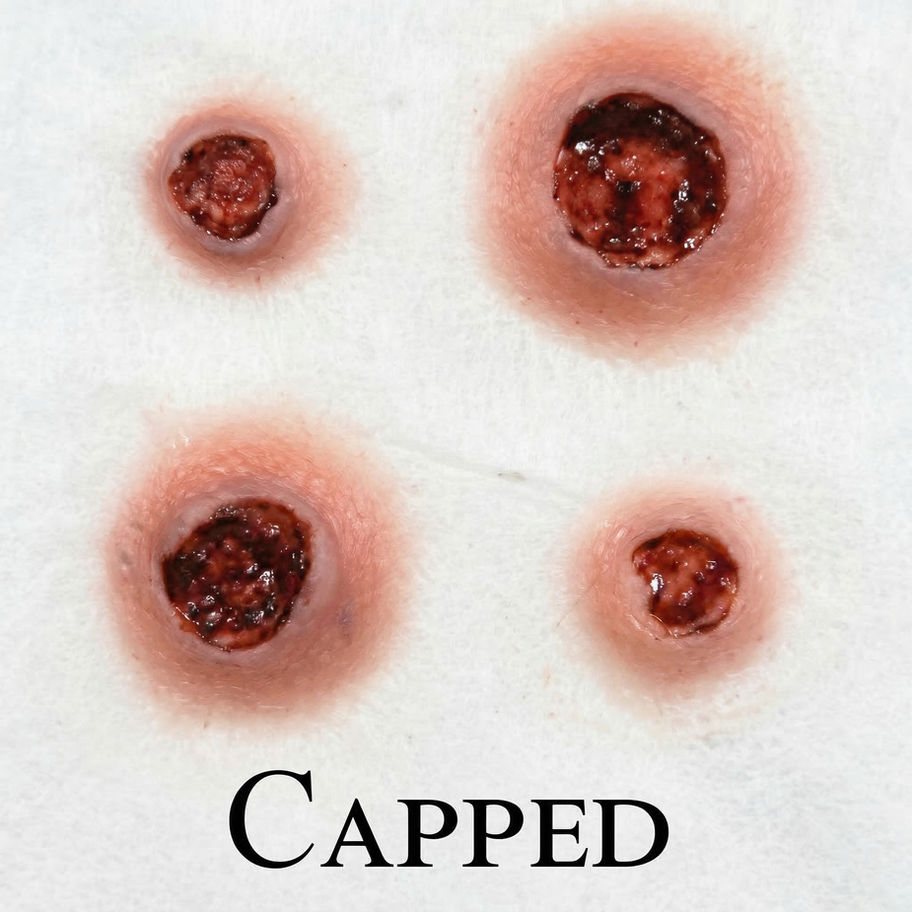 Four simulated capped wounds with text 'CAPPED'