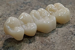 PROTESIS PORCELANA.jpg