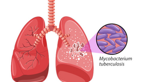 Dia Mundial da Tuberculose