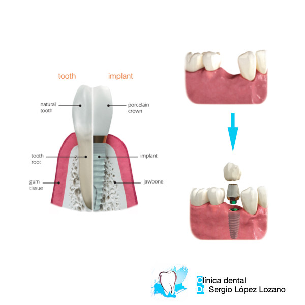 Marcas de implantes dentales mejores marca implante dental biohorizons opiniones murcia Torres de Cotillas implantologo dentista