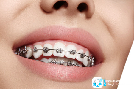 Ortodoncia invisible o brackets diferencia diferencias Invisalign precio ortodoncista tratamiento murcia Torres de Cotillas opiniones cuanto cuesta