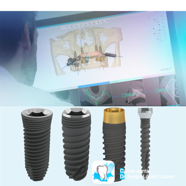 Marcas de implantes dentales mejores marca implante dental opiniones murcia Avinent Torres de Cotillas implantologo dentista