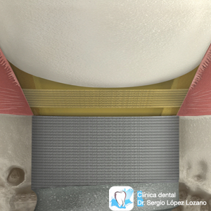 Conexión implante ajuste laser 