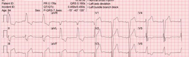 Left Bundle Branch Block.jpg