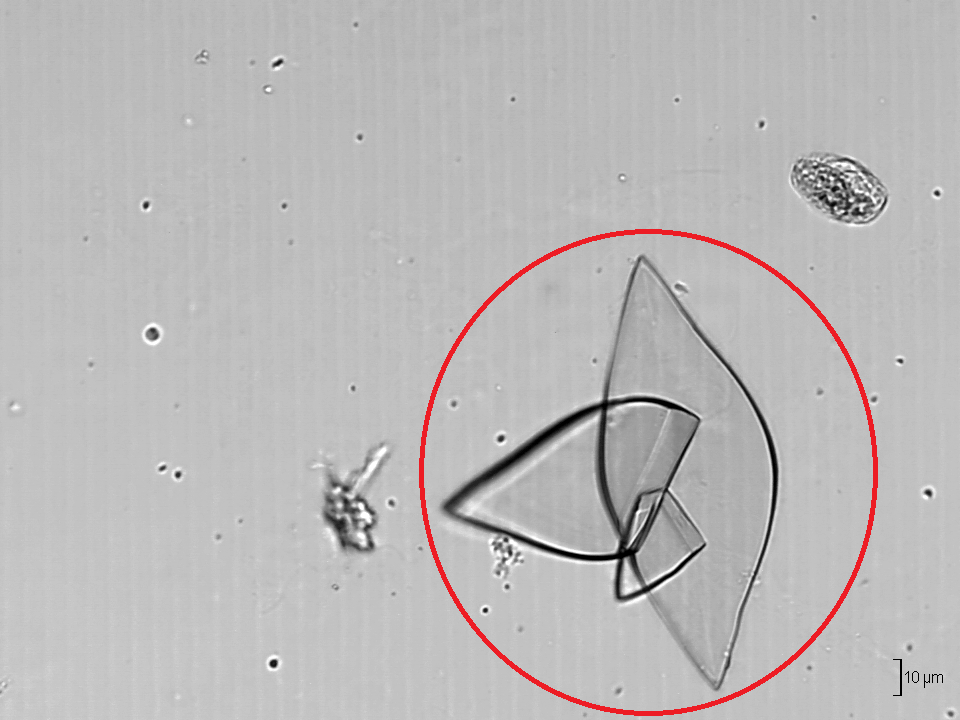 Crystals Commonly Found In Human Urine