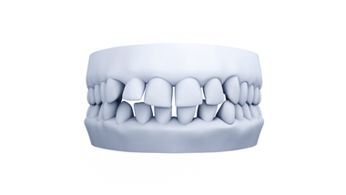 Proligner GapTeeth