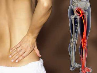 What is Sciatica?