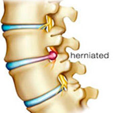 Most Common Causes of Back Pain and Sciatica