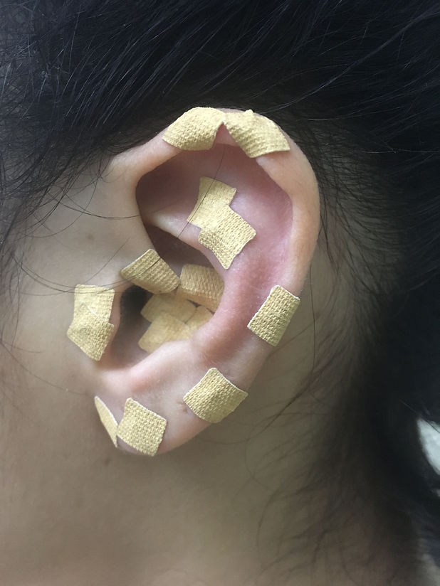 Auriculoterapia-2.JPG