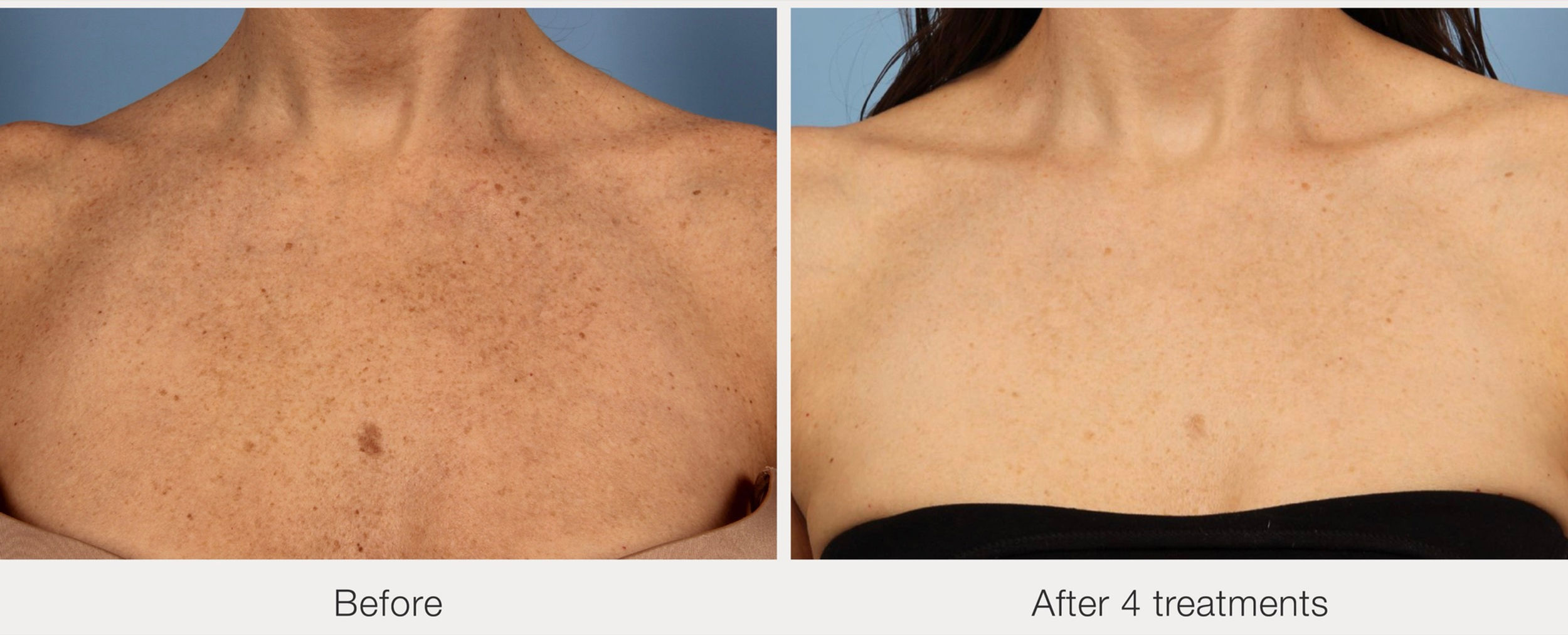 Laser Pigmentation Removal