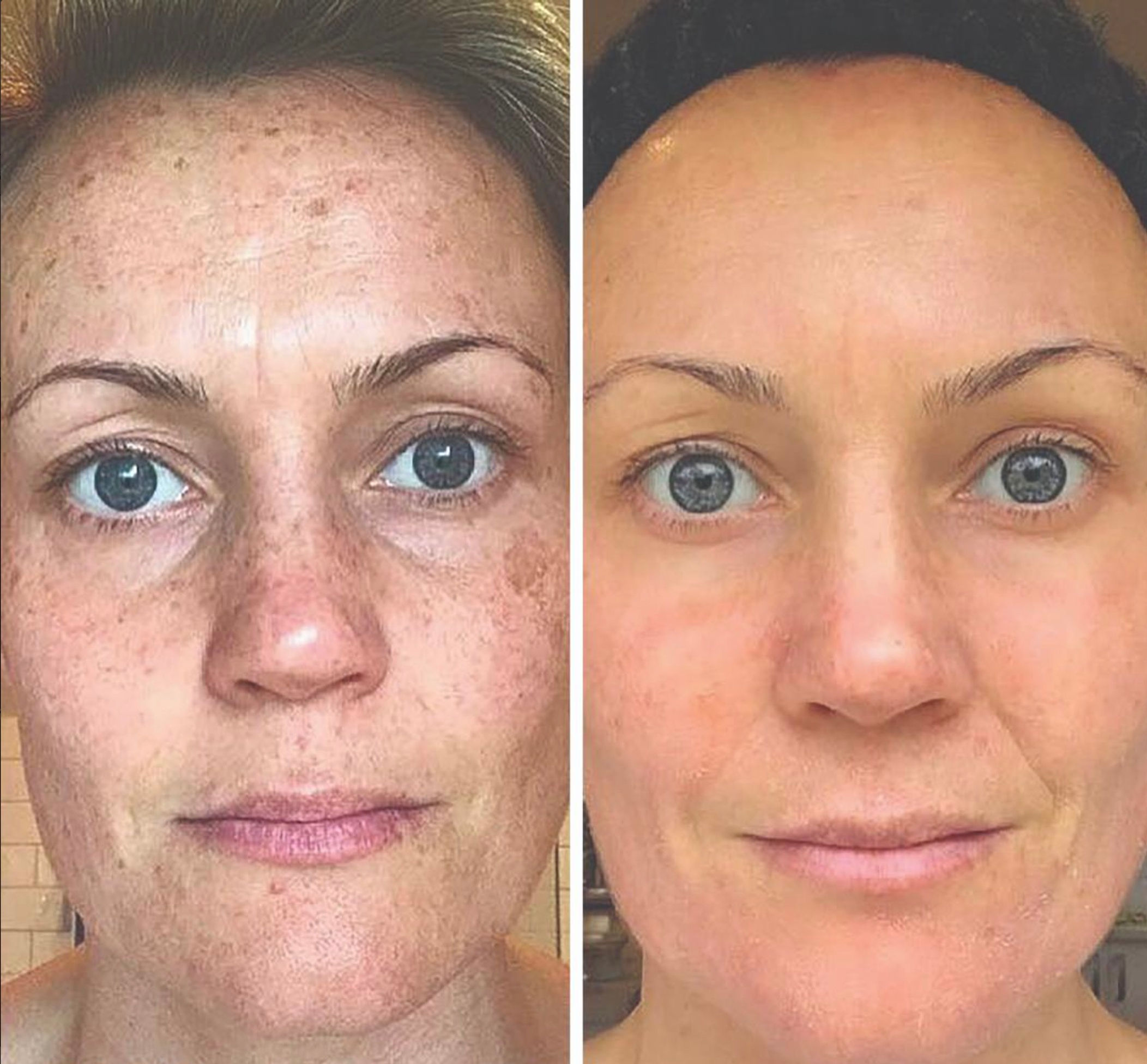 Laser Skin Rejuvenation