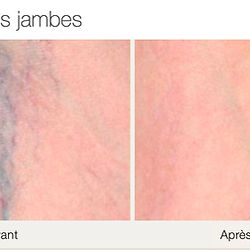 Enlarged blood vessels treatment