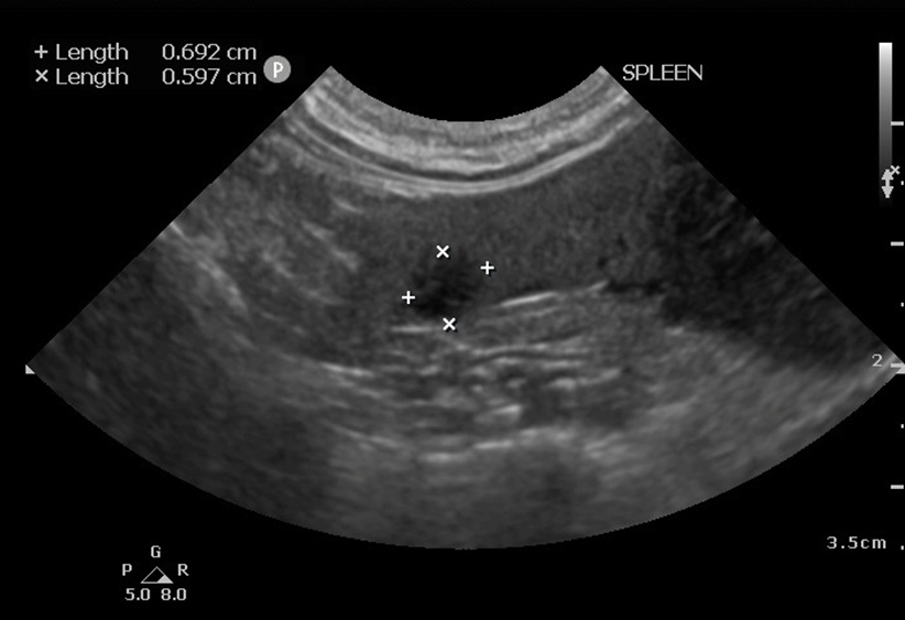Image 5: One other hypoechoic nodule was visible in the splenic parenchyma adjacent to the mass.