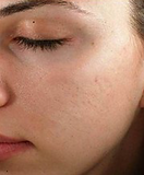 SUBLATIVE REJUVENATION & RESUFACING of the face in a female