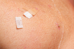 Skin Tag Removal: Understanding the Process and Achieving Clearer Skin