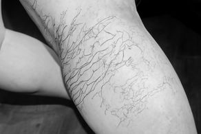 Why Do We Get Varicose Veins?