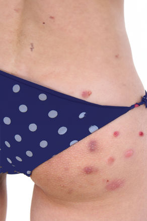 "Buttne" Butt Acne: The Embarrassing Skin Condition That Nobody Talks About