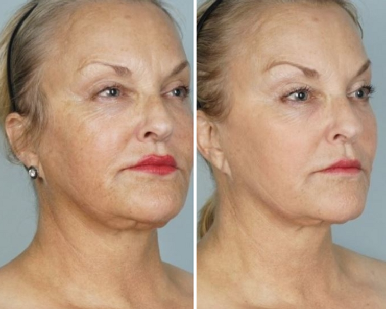 Cool Peel Before and After on a Face