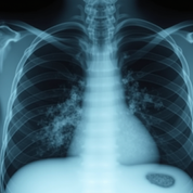 Congenital Cystic Adenomatoid Malformation (CCAM)