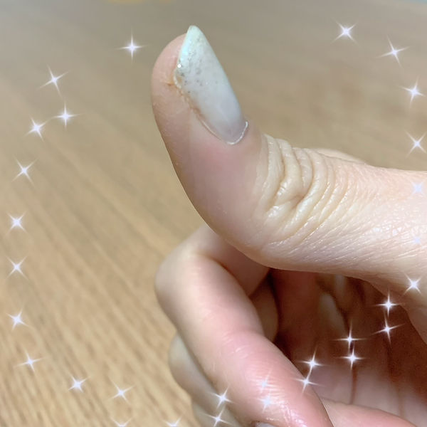 親指のひび割れがきれいになりました 親指のひび割れがきれいになりました