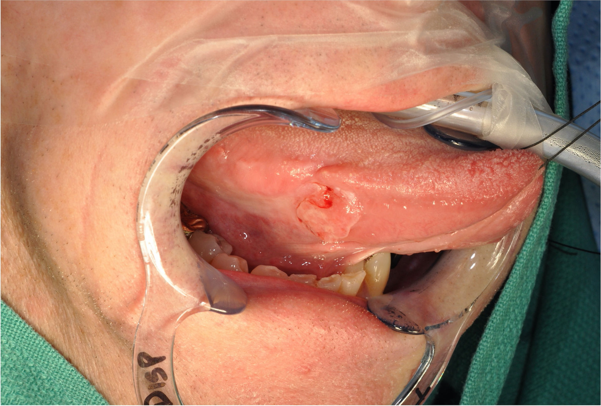 tongue cancer