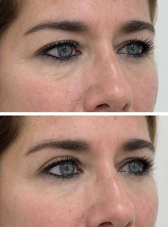 Blefaroplastia-sin-cirugía-en-el-Aljarafe.jpg