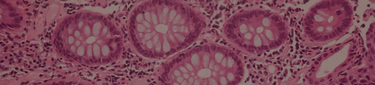 View in microscopic of ductal cell carcinoma adenonocarcinoma from human breast cancer tis