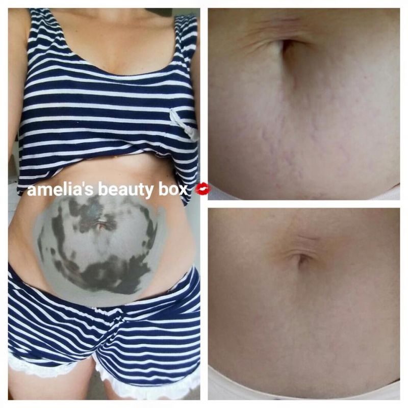 Lermaskin på stretch marks