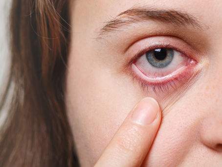 Coceira nos olhos