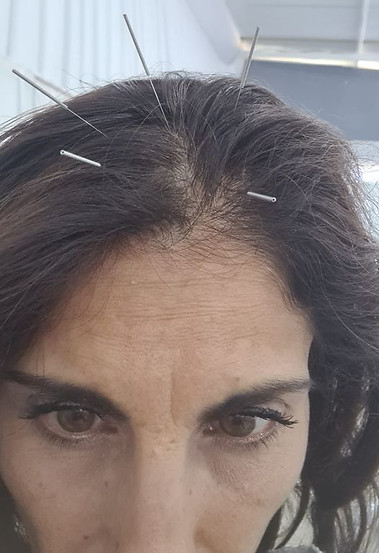 תמונת דיקור.jpg