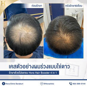 การปลูกผมแบบใช้ยา