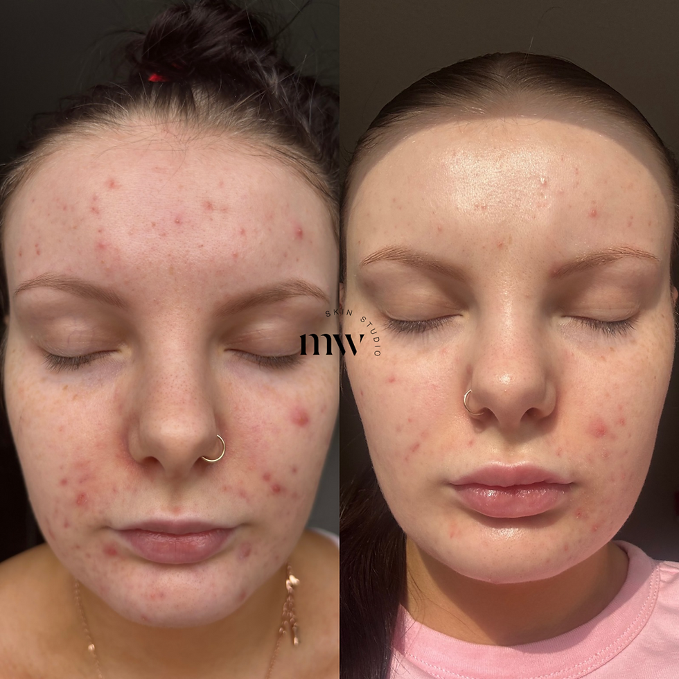 insulin resistance acne