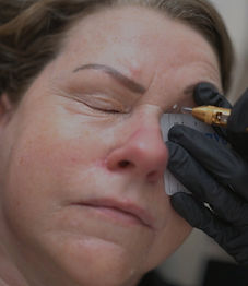 cryotherapy treatment by a skincare specialist