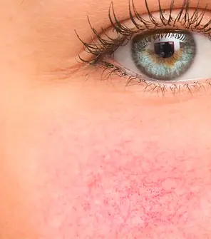 rosacea