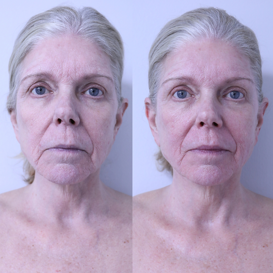 advanced esthetics massage treatment for facial sculpting