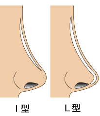 假體隆鼻手術前須知