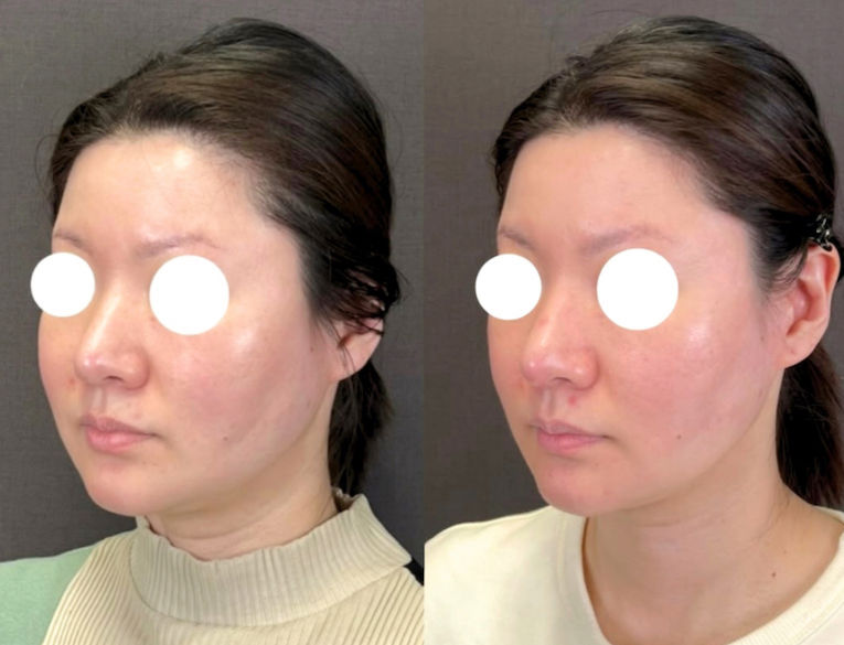 為何不一定要執著於Thermage？帶你認識新一代RF緊膚機種的實力