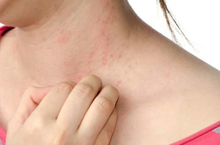 الحساسية التلامسية ( Contact Eczema )