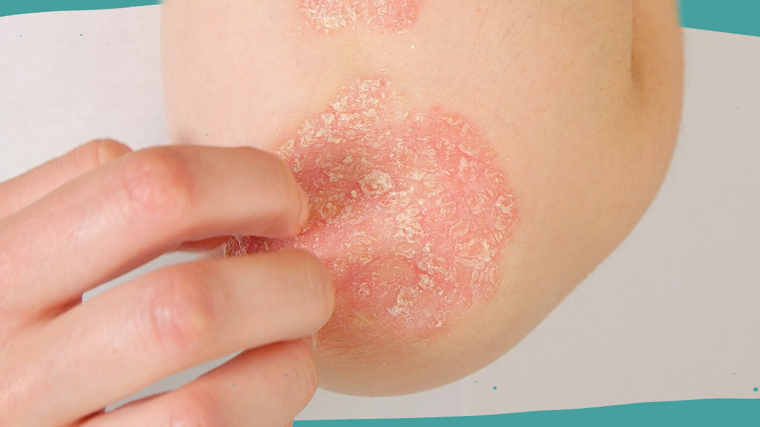 الصدفية ( Psoriasis )