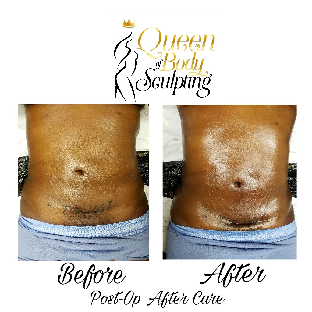 Southfield Queen Of Body Sculpting United States Lymphatic Massage