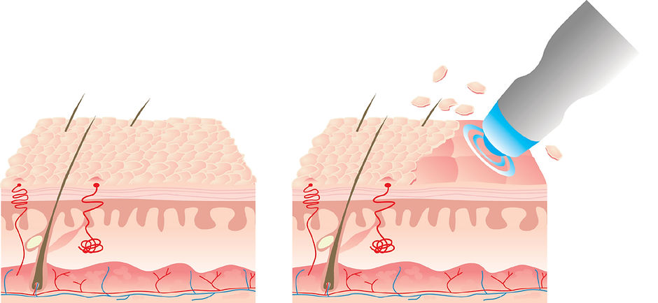 Microdermabrasion Diagram.jpg