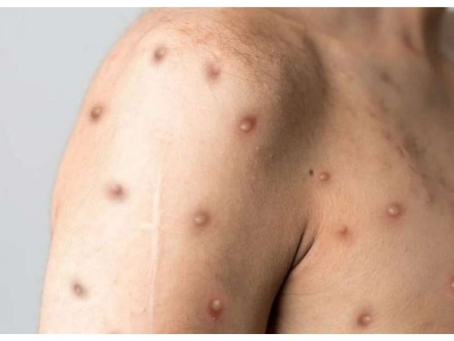 OMS declara mpox como una emergencia internacional de salud pública