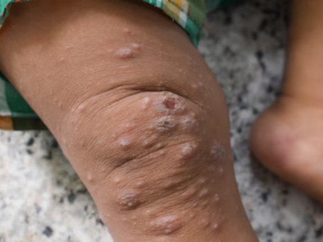 Esto es lo que debes saber sobre la nueva variante de viruela del mono