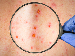 Sarampión golpea a México: más de 10 mil casos y 32 muertes en nueve estados