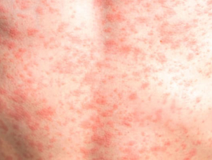 Sarampión: neumonía, inflamación cerebral y otras complicaciones que pueden ser fatales