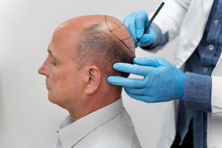 FUE vs FUT: Which Hair Transplant Method is Best for You?