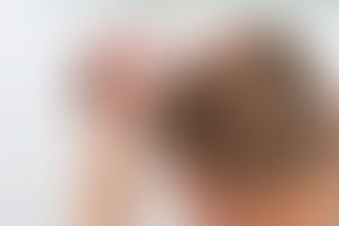 Top 5 Questions Men Ask Before Getting a Hair Transplant